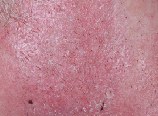 skin image on day eight